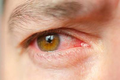 Glokoma karşı erken teşhis uyarısı