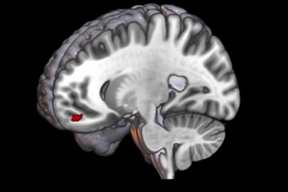 Migrenli beyin 'önemsizi' ayıramıyor, ışık ve desenler ağrıyı tetikliyor