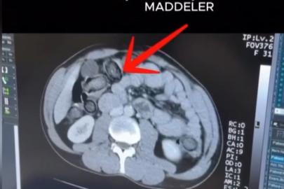 Mideye gizlenen uyuşturucu Erzincan’da ele geçirildi